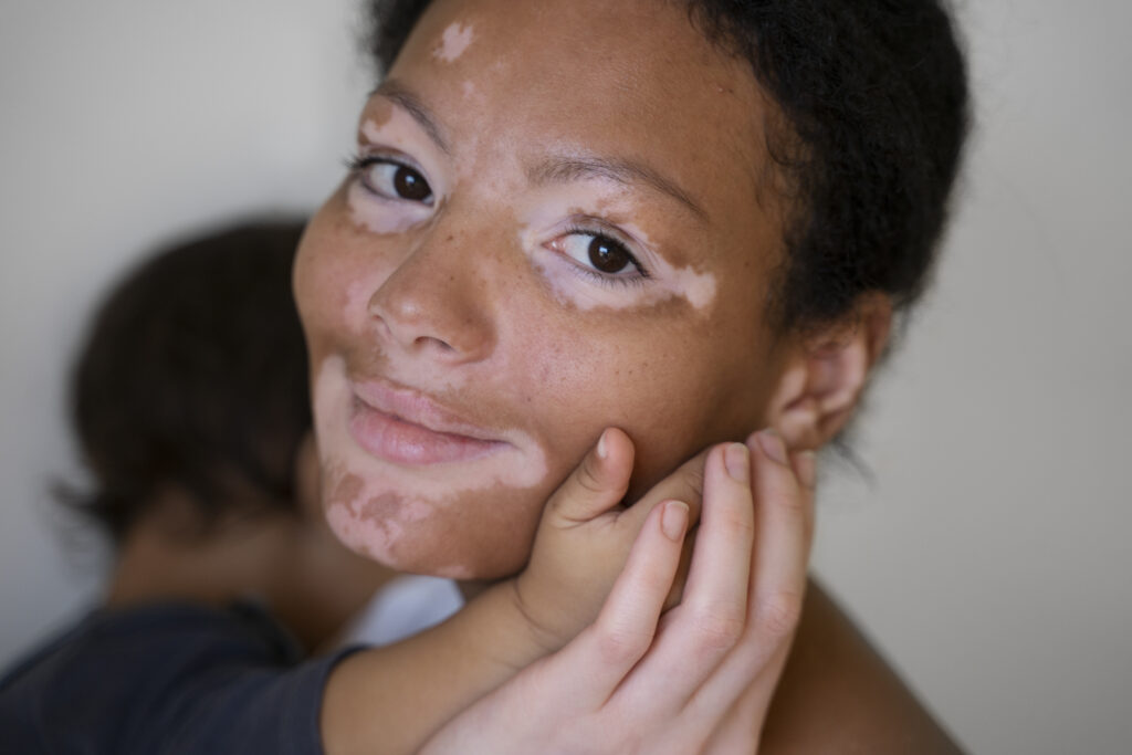 femme atteinte de vitiligo avec son enfant